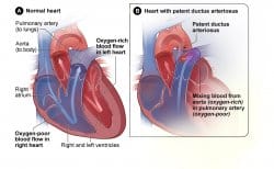 Tetralogy of Fallot and congenital heart disease