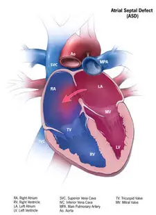 Congenital heart disease and children