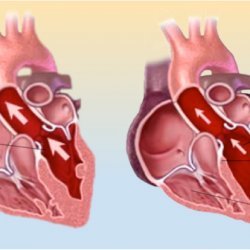 Are cardiomyopathy and heat failure the same thing?Is cardiomyopathy common?