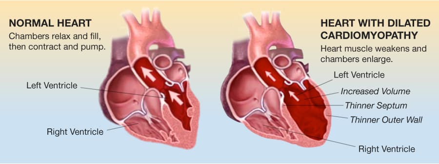 Are cardiomyopathy and heat failure the same thing?Is cardiomyopathy common?