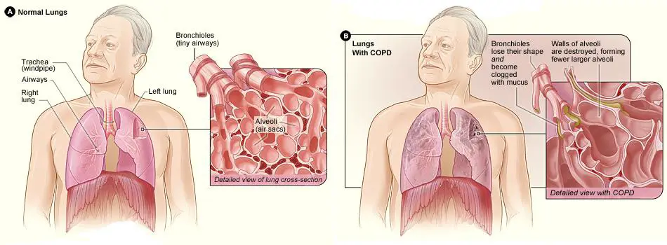 Natural Remedies for COPD