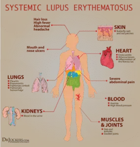 Coronary artery disease is one of the major complications of Lupus. Cardiovascular disease. systemic lupus erythematosus. 