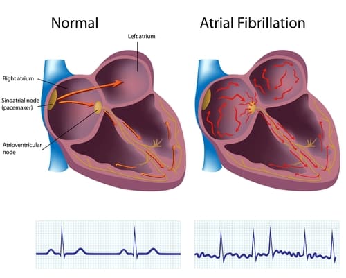 atrial fibrillation treatment Is atrial fibrillation dangerous? Can atrial afib cause a stroke? Can atrial fib be cured?