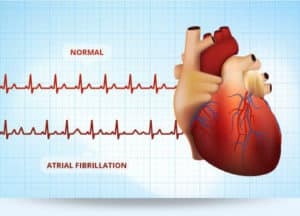 atrial fib and high blood pressure afib atrial fibrillation