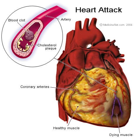 what is coronary artery disease