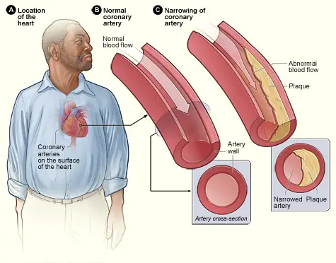 what is coronary artery disease