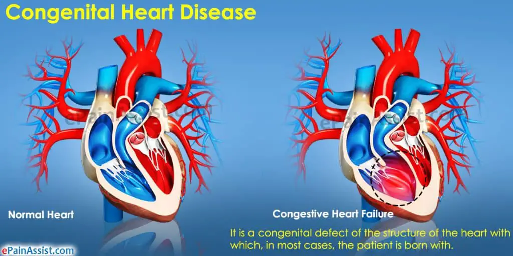 congenital heart disease