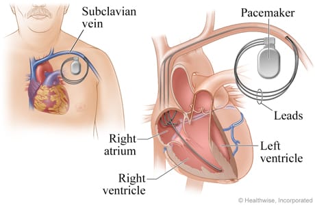 Cardiac resynchronization therapy (CRT) is a procedure used to treat problems with how your heart beats. Cardiac Resynchronization is also called biventricular pacing. CRT is used to help with severe congestive heart failure. It can also prevent atrial fibrillation. This article will discuss Cardiac Resynchronization Therapy (CRT): Overview, History, and Uses