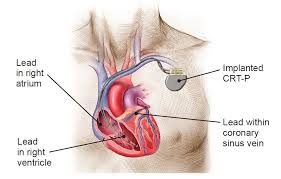 Cardiac resynchronization therapy (CRT) is a procedure used to treat problems with how your heart beats. Cardiac Resynchronization is also called biventricular pacing. CRT is used to help with severe congestive heart failure. It can also prevent atrial fibrillation. This article will discuss Cardiac Resynchronization Therapy (CRT): Overview, History, and Uses