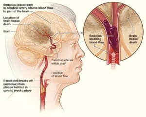 signs of a stroke, low salt, low sodium