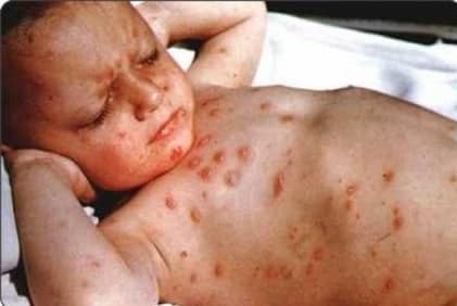 Beriberi pictures, beriberi images, beriberi disease images, 