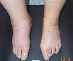 swollen ankles pictures