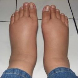 Swollen feet and heart problems, heart problems and swollen feet,