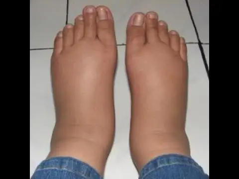 Pictures of Swollen Ankles Due to Congestive Heart Failure, swollen ankle pictures, pictures of swollen ankles due to ongestive heart failure