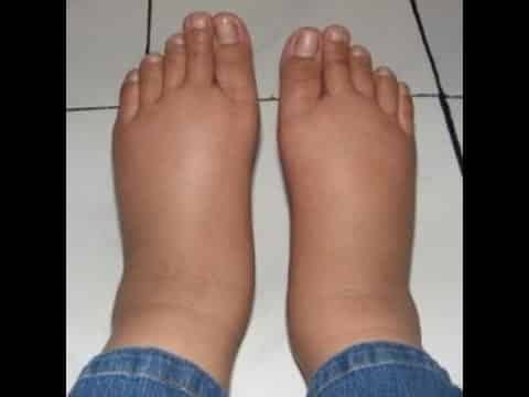 Beriberi Thiamine Deficiency Beriberi Pictures And Images Beriberi Thiamine Deficiency Beriberi Pictures And Images