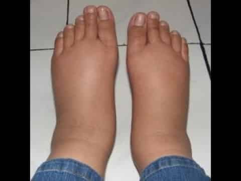 Swollen feet and heart problems, heart problems and swollen feet,