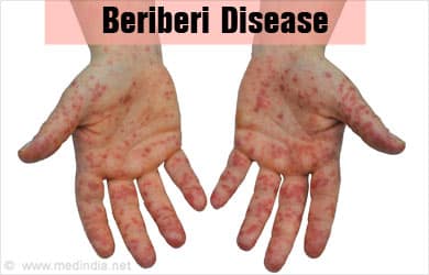 beriberi definition, beriberi deficiency disease, wet beriberi images