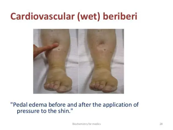 Beriberi Thiamine Deficiency Beriberi Pictures And Images Beriberi Thiamine Deficiency Beriberi Pictures And Images