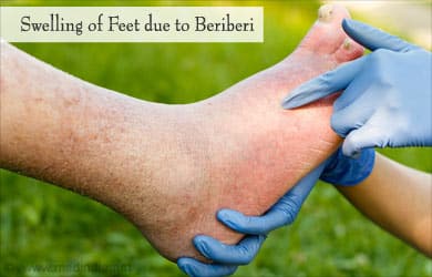 beriberi definition, beriberi images, beriberi disease pictures, Beriberi facts