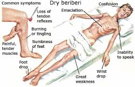 The causes of beriberi and how to prevent it.