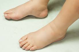 swollen ankles, swollen feet and heart problems