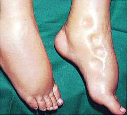 Pictures of Swollen Ankles Due to Congestive Heart Failure, picture of a swollen feet, ankle heart, chf feet