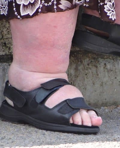 pictures of swollen ankles, congestive heart failure swelling. 