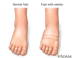 pictures of swollen ankles
