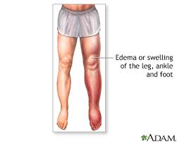 pictures of swollen ankles