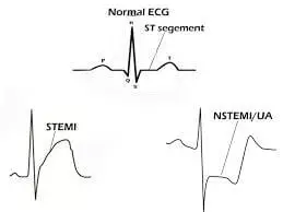 What Does an EKG Look Like In a Heart Attack With Pictures, heart attack on a EKG