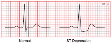Ekg look like in a heart attack What Does an EKG Look Like In a Heart Attack With Pictures