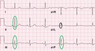 What Does an EKG Look Like In a Heart Attack With Pictures