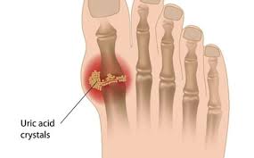 How To Treat Gout Homeopathically