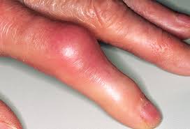How to Cure Gout Naturally With Food How to Ease the Pain of Gout Naturally