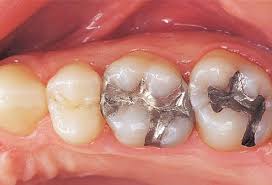 Dental Infection and Heart Disease