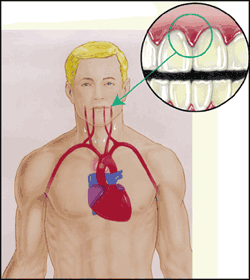 Dental Infection and Heart Disease