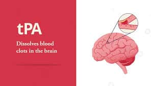 Atrial Fib and Cardioembolic Stroke With tPA