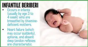 How to prevent beriberi in pregnanc. The only way to prevent beriberi is to have adequate Thiamine in your diet.