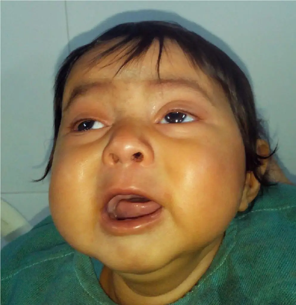 Beriberi (Thiamine Deficiency) Beriberi Pictures And Images