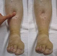 Beriberi: Overview, Types, Symptoms and Prevention Beriberi: Overview, Types, Symptoms and Prevention pics