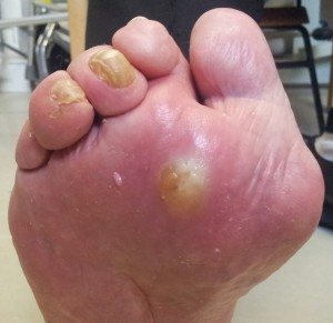 The Best Diabetic NeuropathyWounds And Foot Pain Solutions Best Diabetic Neuropathy Wounds