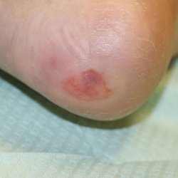 The Best Diabetic NeuropathyWounds And Foot Pain Solutions