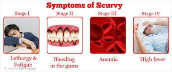 Scurvy Symptoms in Children