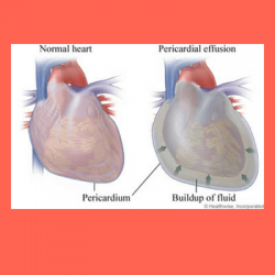 Pericardial effusion and pericardial window.