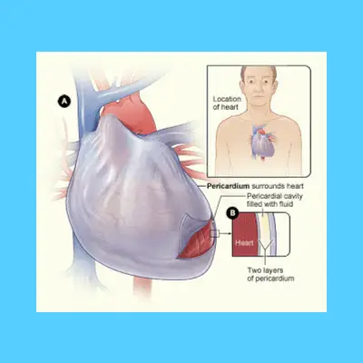 Pericardial effusion and pericardial window