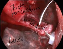 Pericardial Window Pictures