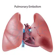 What is a pulmonary embolism? Why are pulmonary embolism dangerous?