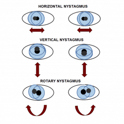 Wernicke encephalopathy