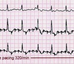 Can you die from atrial flutter? Atrial flutter treatment