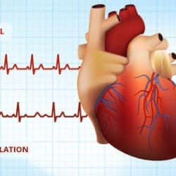 Atrial flutter treatment, atrial flutter causes,